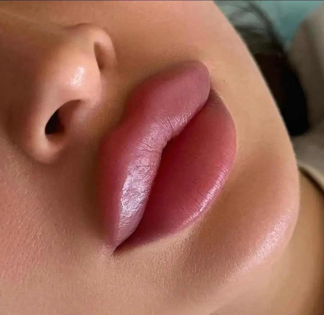 پزشک مزو ژل بوتاکس لب گونه چشم چانه زاویه فیلر prp|خدمات آرایشگری و زیبایی|کرج, گوهردشت|دیوار