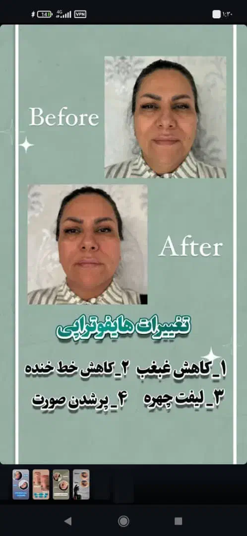 هایفوتراپی ۷بعدی تخفیف ویژه برای اولین ها|خدمات آرایشگری و زیبایی|قم, صدوق|دیوار