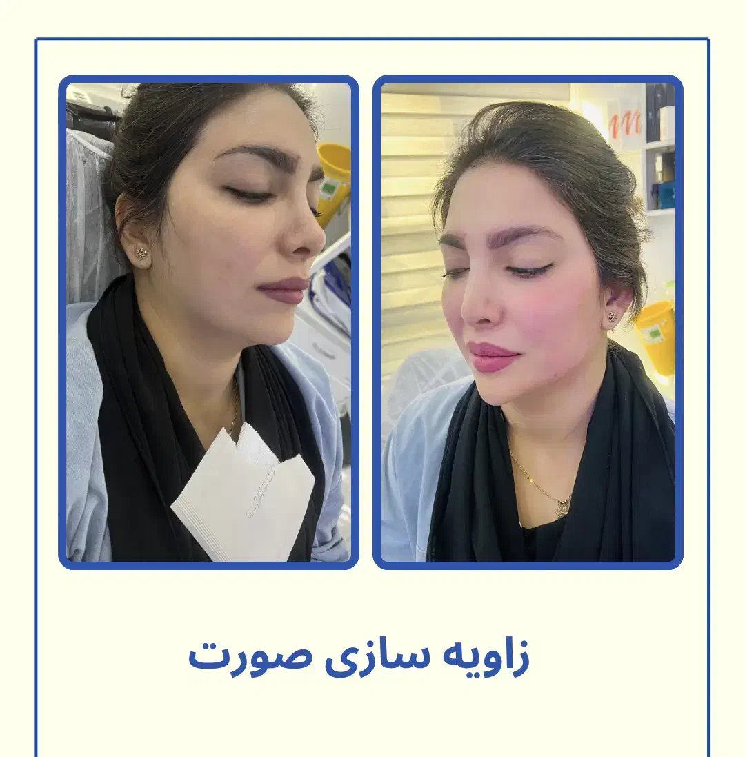 فیلر لب روسی -زاویه سازی -بوتاکس-پی ار پی -مزو|خدمات آرایشگری و زیبایی|تهران, دریا|دیوار