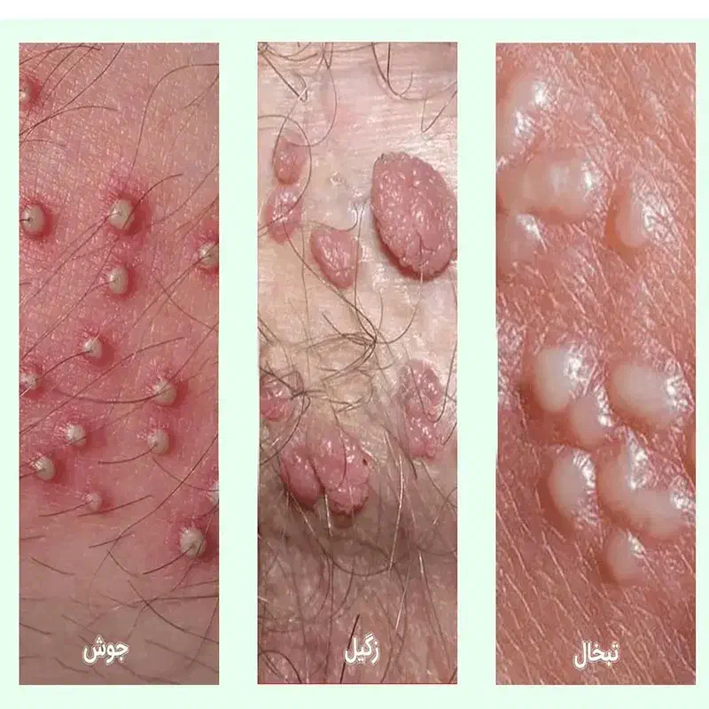 زگیل تناسلیhpv و مشکلات جنسی|خدمات آرایشگری و زیبایی|مینودشت, |دیوار