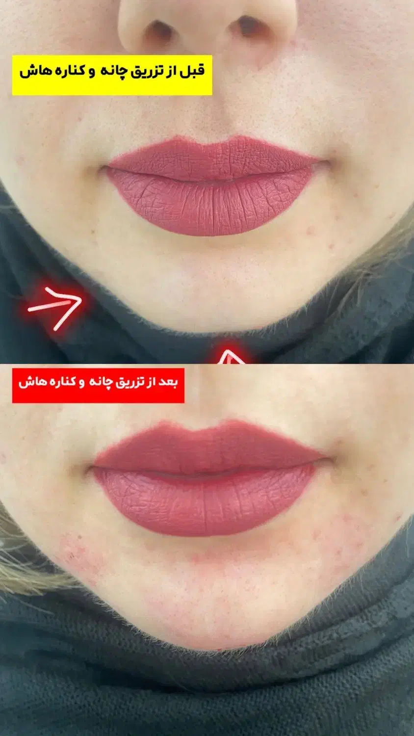 تزریقات. و جوانسازی پوست با فیلر و بوتاکس|آرایشی، بهداشتی، درمانی|اهواز, زیتون کارگری|دیوار