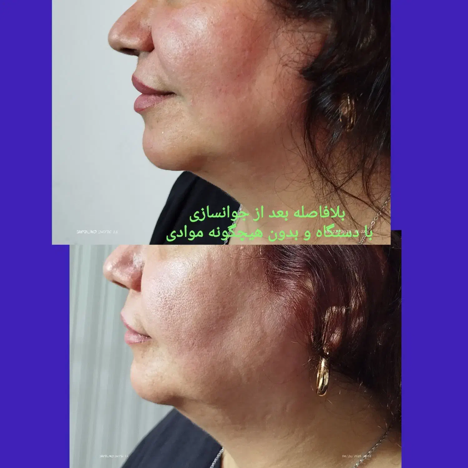 جوانسازی قوی بدون مواد|خدمات آرایشگری و زیبایی|رشت, کاکتوس|دیوار