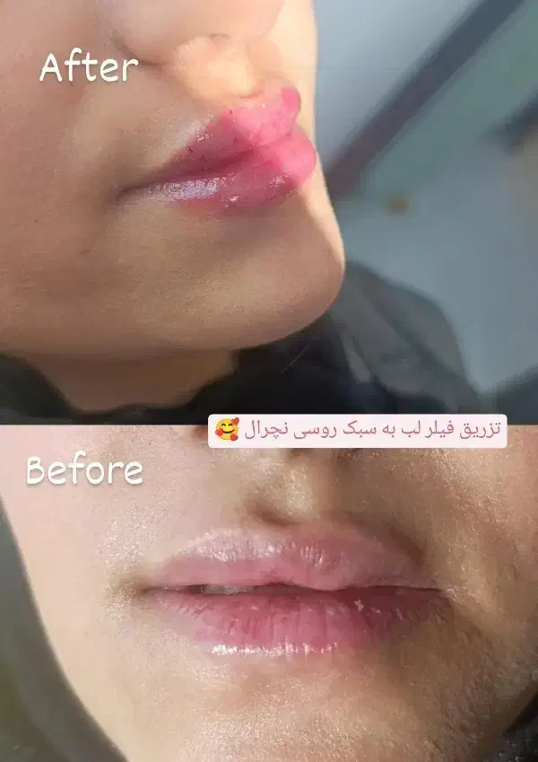 تخفیفات روزمادر تزریق ژل بوتاکس،مزوتراپی،فیلر بادی|خدمات آرایشگری و زیبایی|قم, باسکول|دیوار