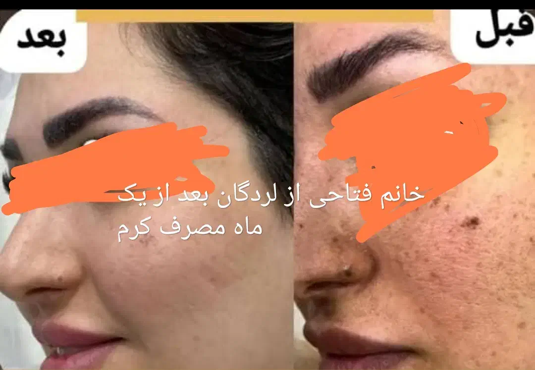 کرم معجزه اصل ضد لک و جوش سفید شدن پوست ضمانتی|آرایشی، بهداشتی، درمانی|لردگان, |دیوار