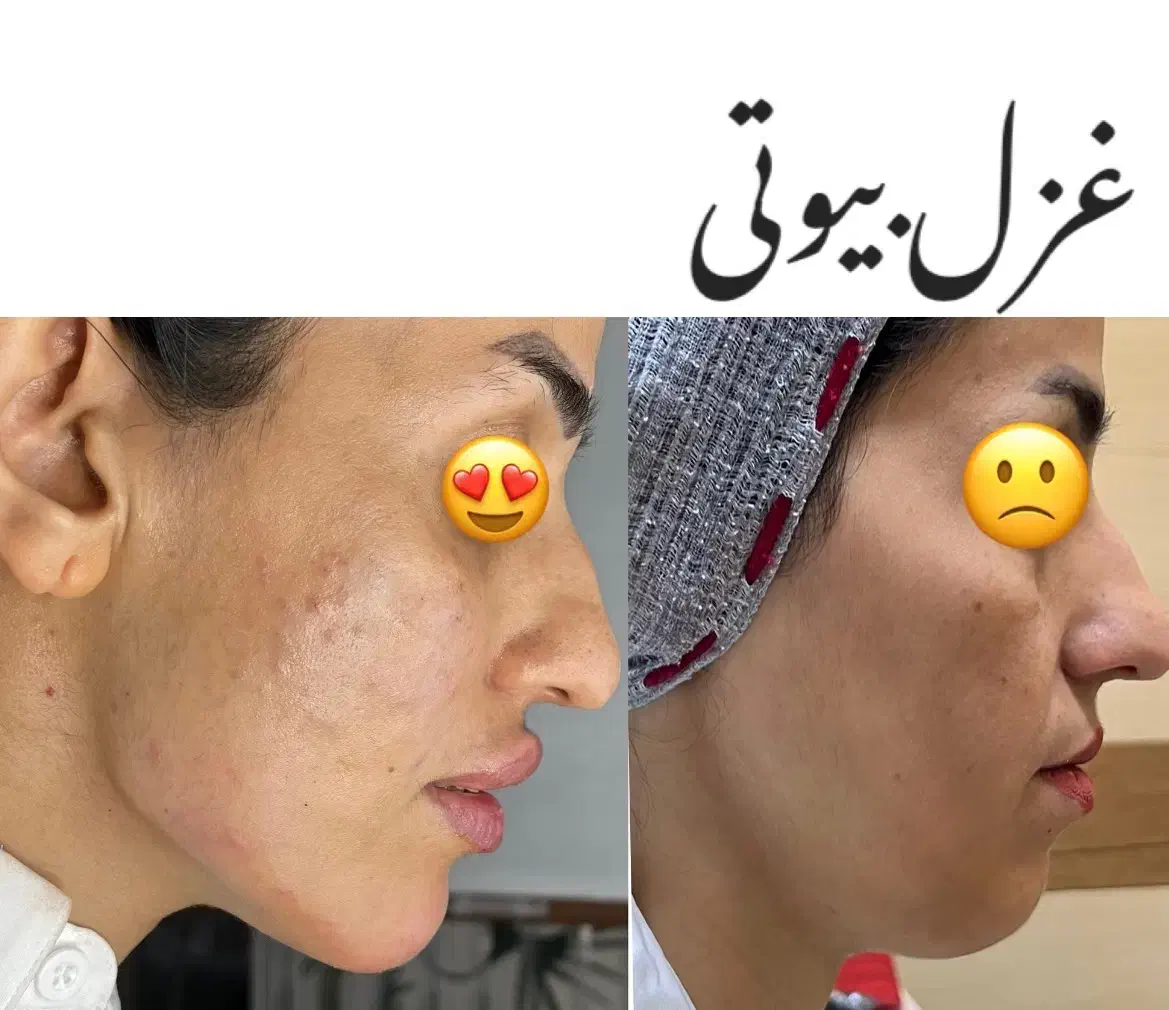 تزریق ژل بوتاکس چربیسوزی آنزیم جوانسازی|خدمات آرایشگری و زیبایی|اهواز, کیانپارس |دیوار