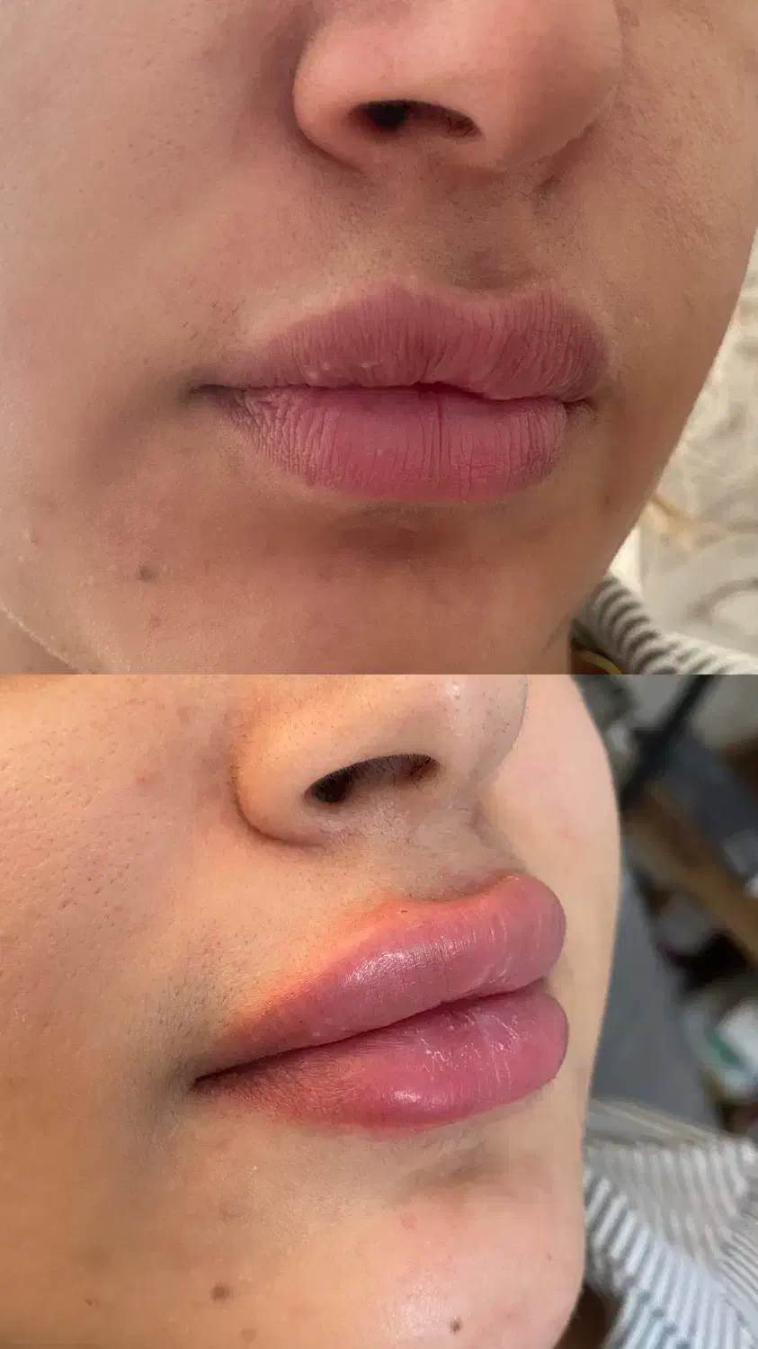 تخفیف۵۰٪ بوتاکس و فیلر (فقط یک هفته)|خدمات آرایشگری و زیبایی|ری, شهرری|دیوار