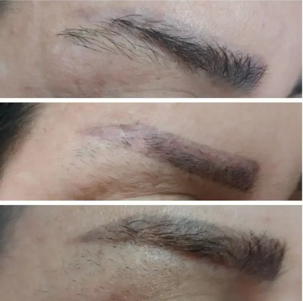 ریموو درمانی تتو های بدرنگ قدیمی|خدمات آرایشگری و زیبایی|الشتر, |دیوار