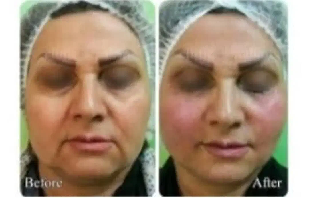 مدل ژل و بوتاکس زیر نظر پزشک در درمانگاه|خدمات آرایشگری و زیبایی|اهواز, شریعتی جنوبی|دیوار