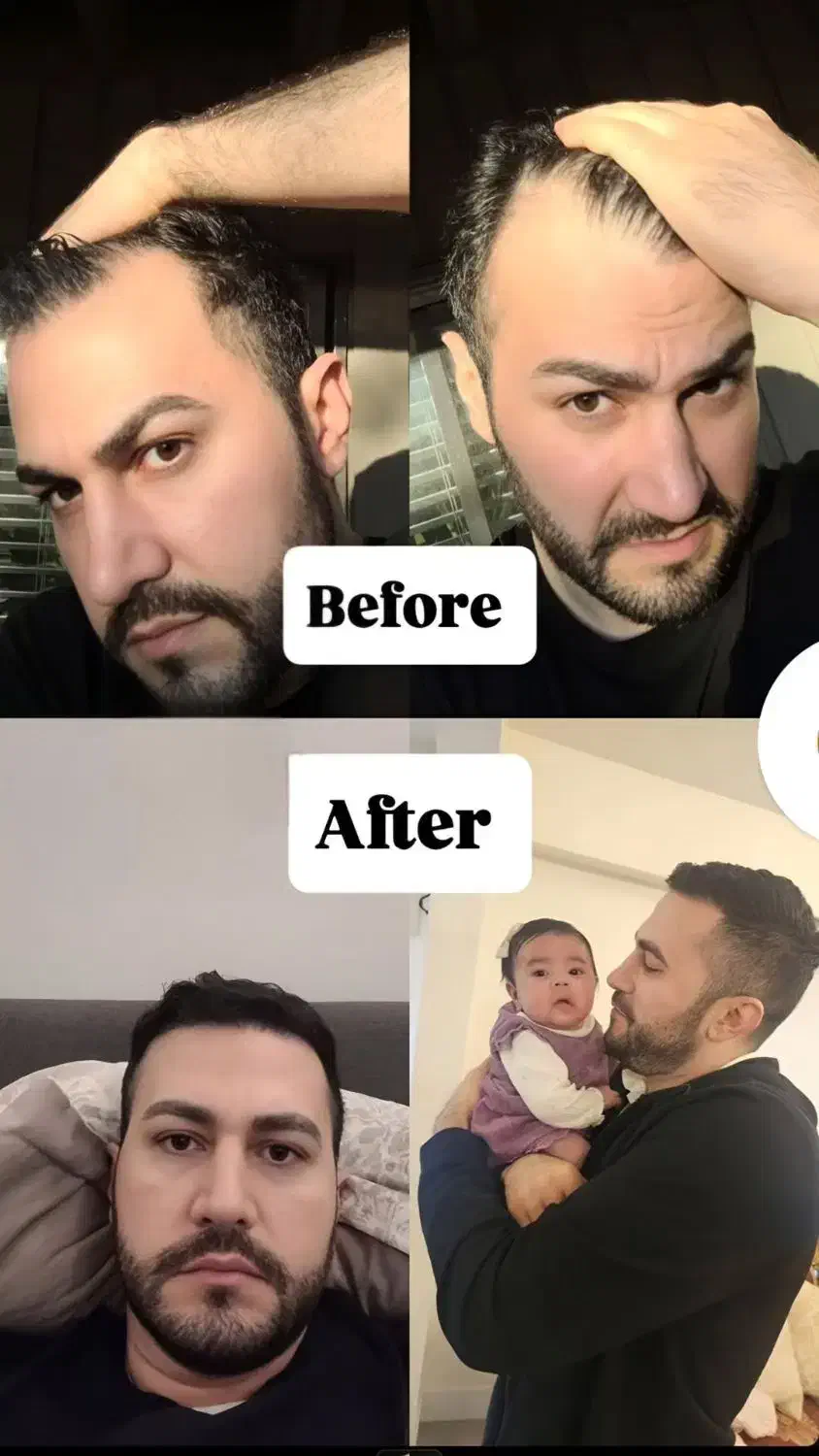 کاشت مو در شیراز+یک شب اقامت رایگان فقط ۱۶۹۰۰|خدمات آرایشگری و زیبایی|تهران, کوثر|دیوار