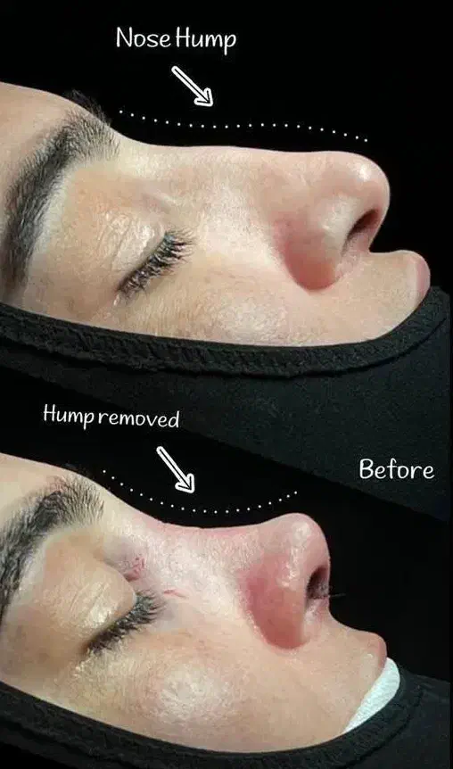 عمل بینی|خدمات آرایشگری و زیبایی|کرج, عظیمیه|دیوار