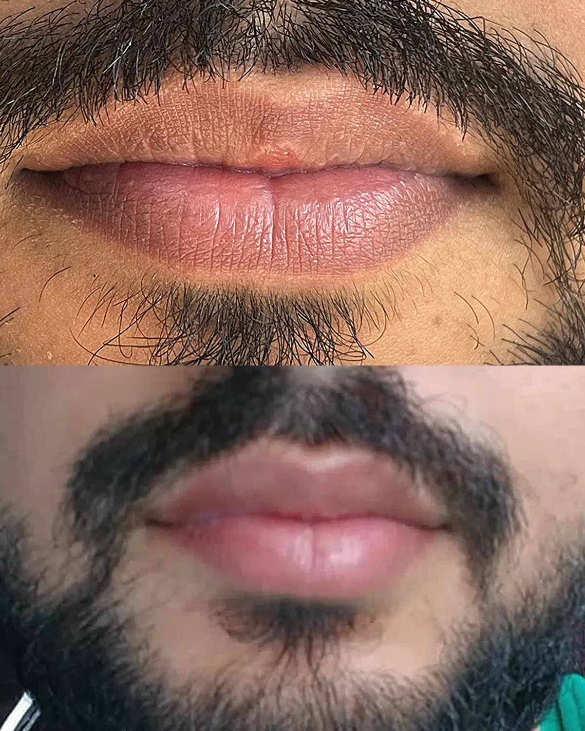 رفع تیرگی دائمی لب (فقط آقایان)|خدمات آرایشگری و زیبایی|اهواز, سپیدار|دیوار
