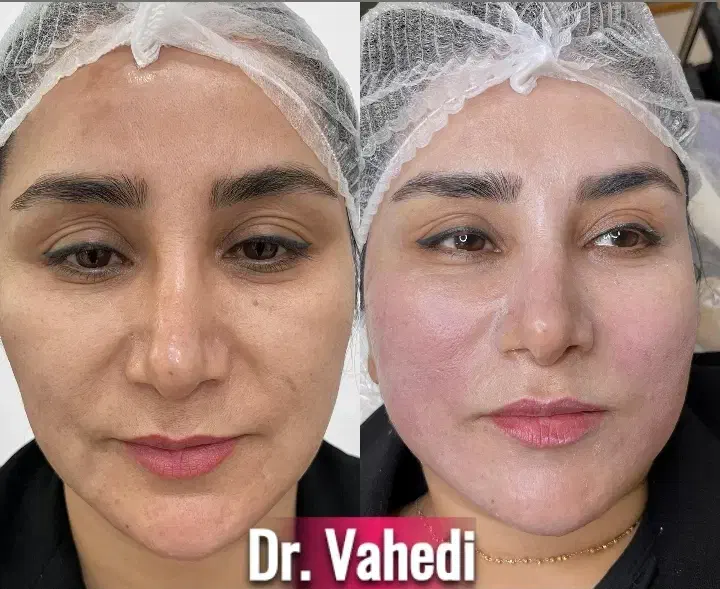 تخفیف ویژه لیفت و جوانسازی صورت|خدمات آرایشگری و زیبایی|مشهد, چهارچشمه|دیوار