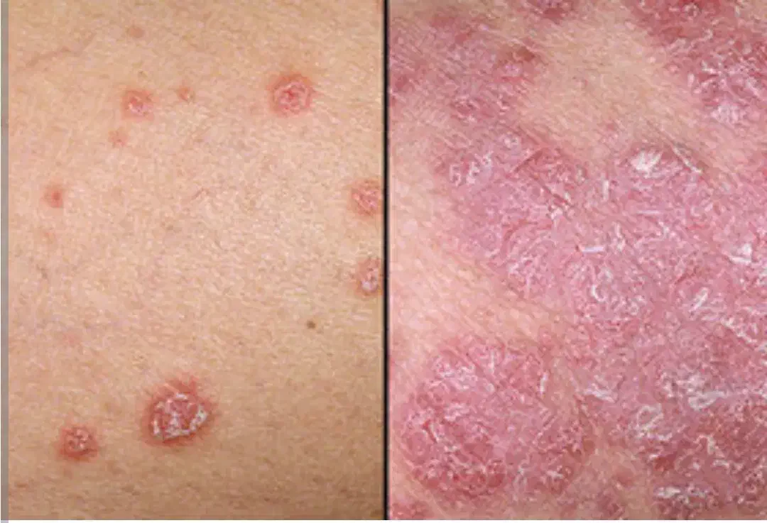 درمان پسوریازیس به صورت ریشه ای|آرایشی، بهداشتی، درمانی|جیرفت, |دیوار