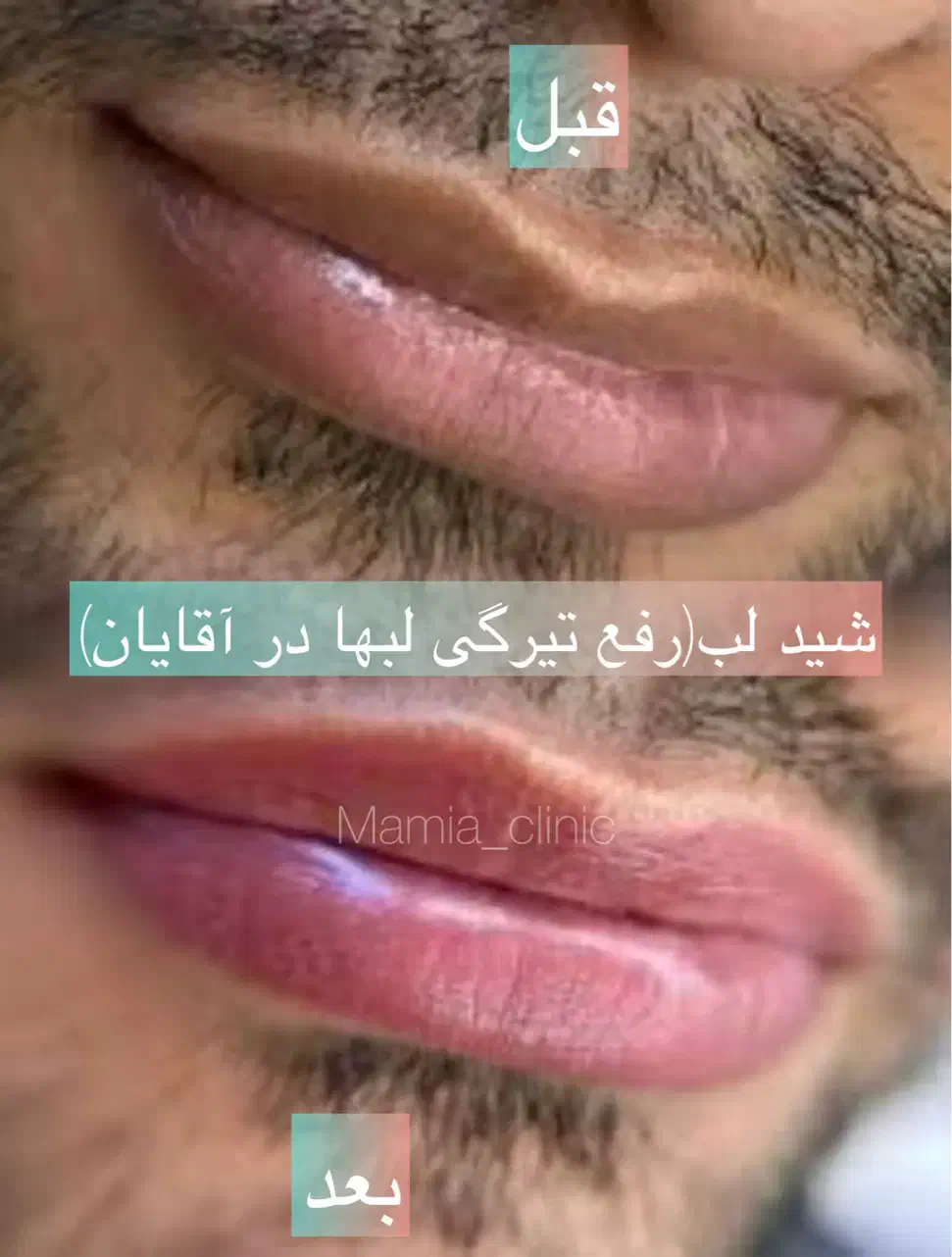 شید لب/رژلب/رفع لب تیره/مزووایت کرمپودر دایم|خدمات آرایشگری و زیبایی|اهواز, فرهنگ شهر|دیوار