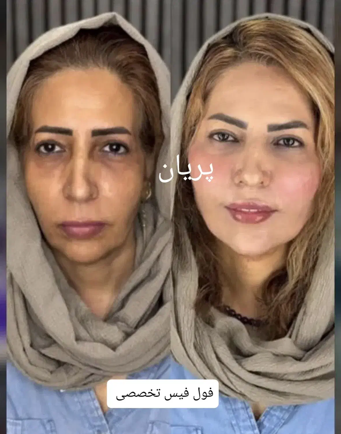 جشنواره فیلر فول فیس ژل بوتاکس نخ هایفو ساکشن|خدمات آرایشگری و زیبایی|مشهد, فرهنگ|دیوار