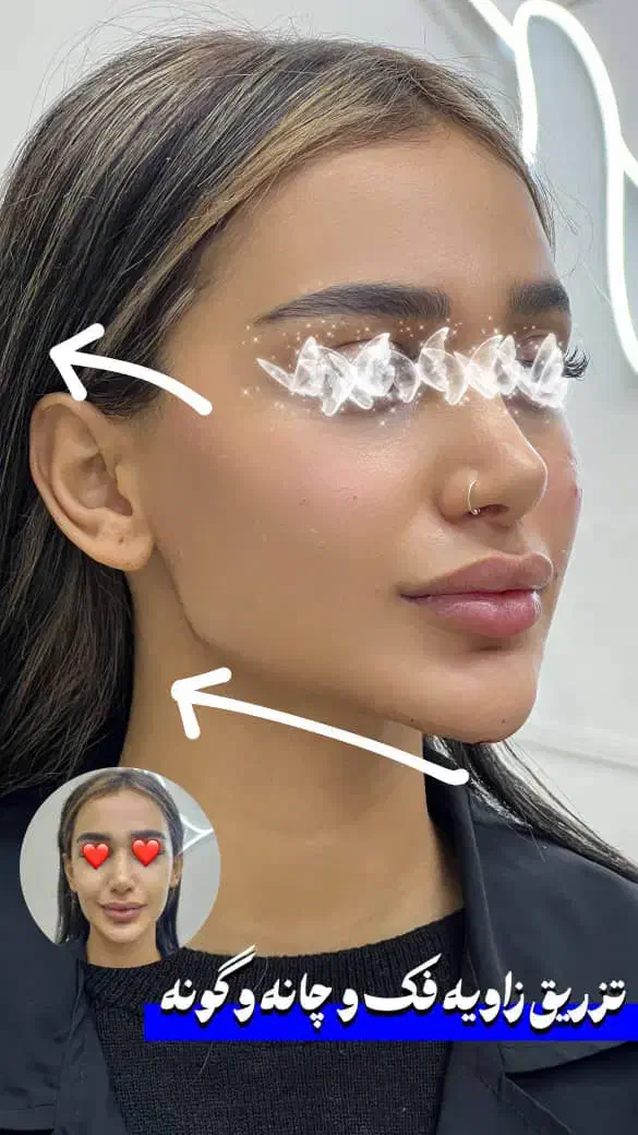 جشنواره تخفیف تزریق ژل و بوتاکس کانتورینگ فیشیال|خدمات آرایشگری و زیبایی|کرج, گلشهر|دیوار