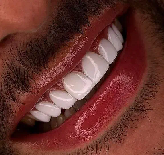 کامپوزیت دندان|خدمات آرایشگری و زیبایی|اردبیل, |دیوار