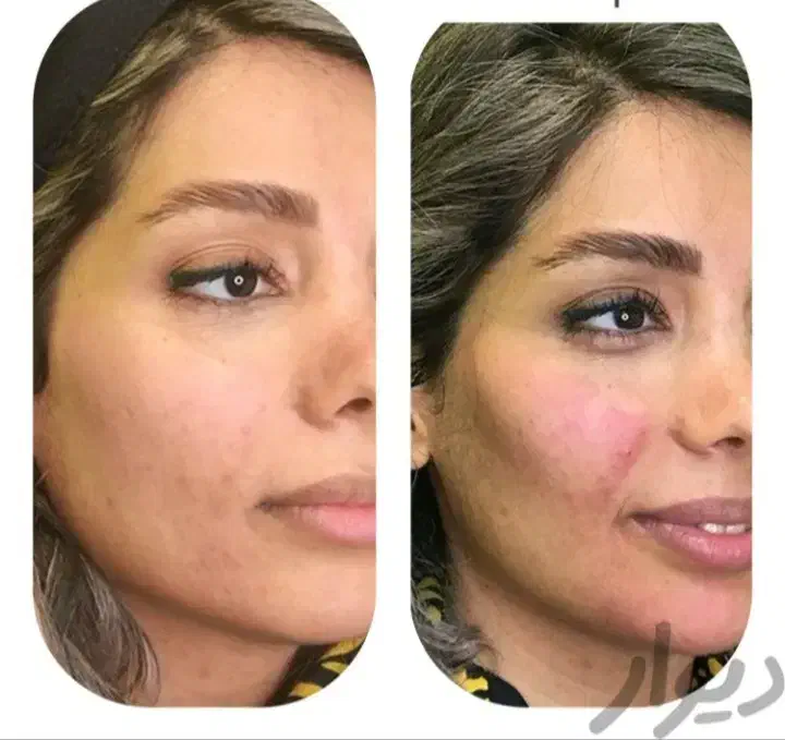 تزریق، فیلر ، بوتاکس، ژل ، آنزیم|خدمات آرایشگری و زیبایی|شیراز, سینما سعدی|دیوار