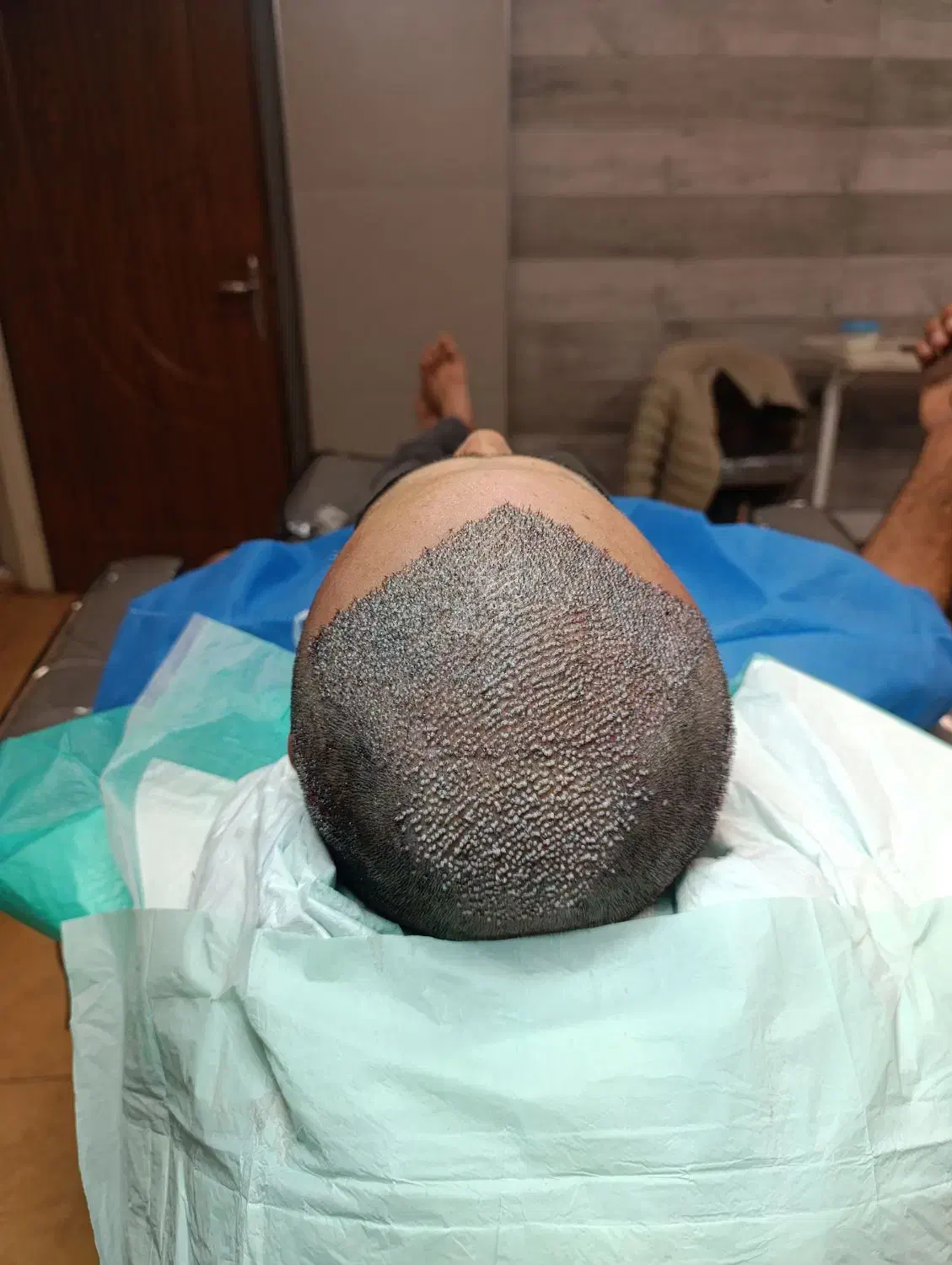 کاشت مو به روش Sp|خدمات آرایشگری و زیبایی|آذرشهر, |دیوار