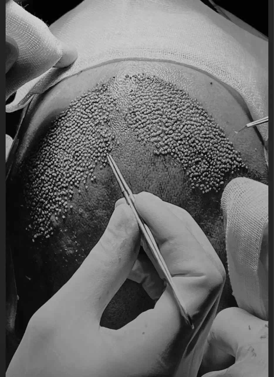 کاشت ابرو و مو با تیم تخصصی در کلینیک معتبر|خدمات آرایشگری و زیبایی|رشت, بوسار|دیوار