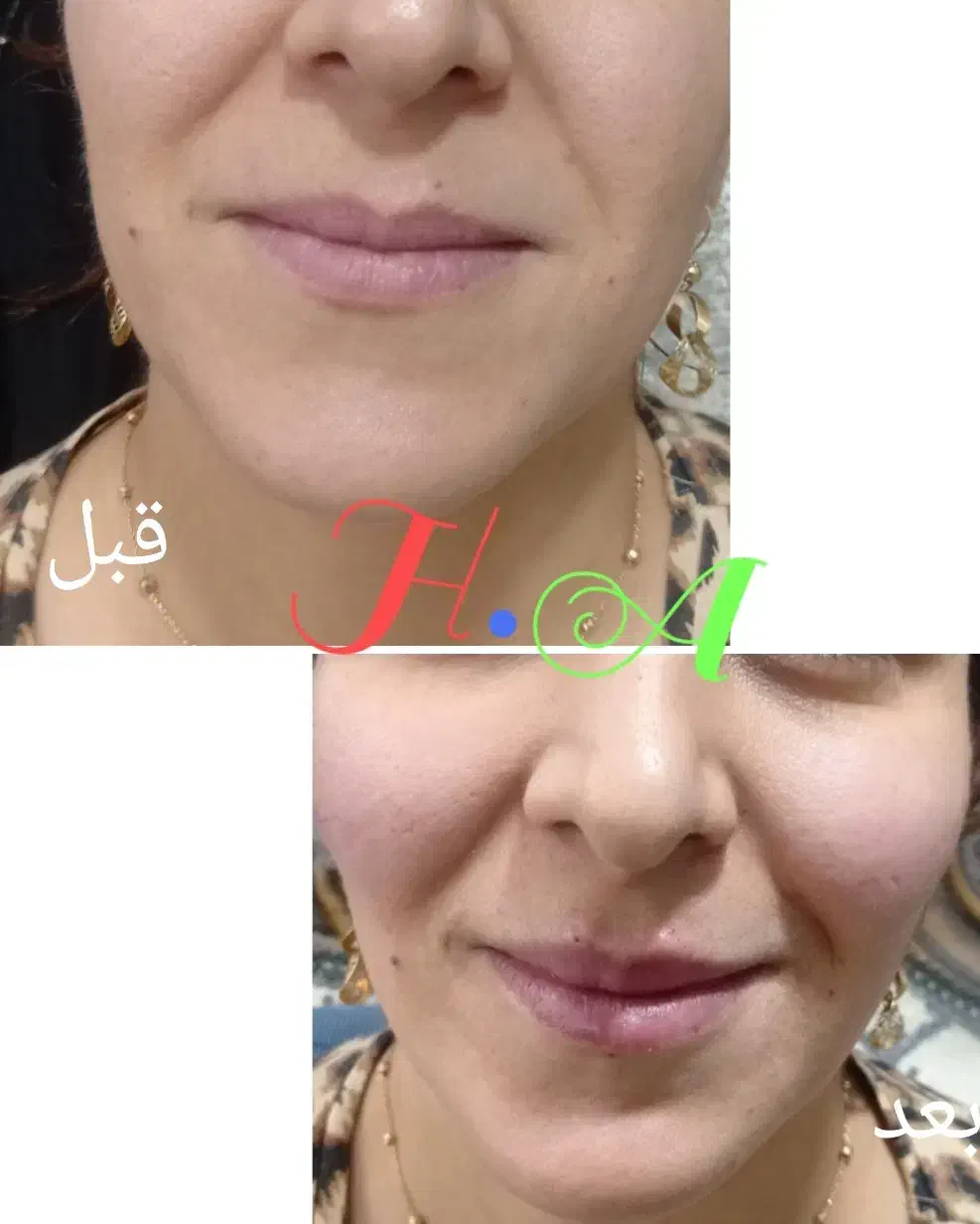 جشنواره ژل و بوتاکس درکلینیک پوست ومو|خدمات آرایشگری و زیبایی|شاهینشهر, فردوسی|دیوار