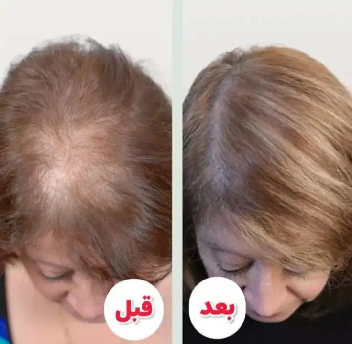 محلول ضد ریزش مو|آرایشی، بهداشتی، درمانی|بندر انزلی, آذربایجان|دیوار