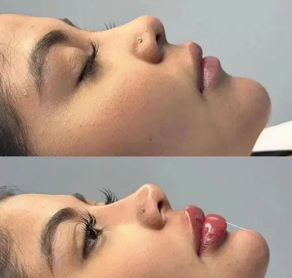 بوتاکس ژل لب گونه چانه فک پر کردن صورت لاغر نخ مزو|خدمات آرایشگری و زیبایی|قم, زنبیل آباد|دیوار