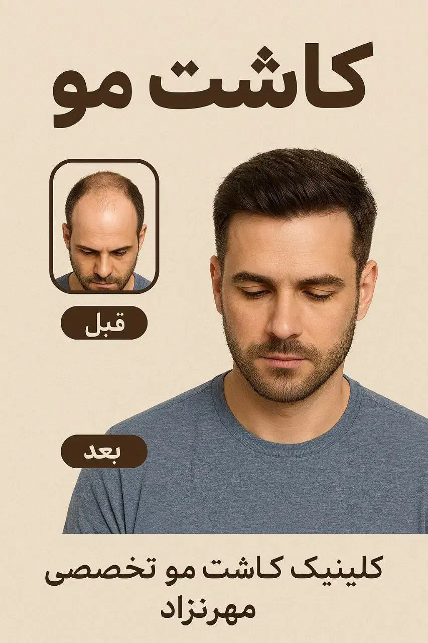 کاشت مو با شرایط ویژه|خدمات آرایشگری و زیبایی|میاندوآب, |دیوار