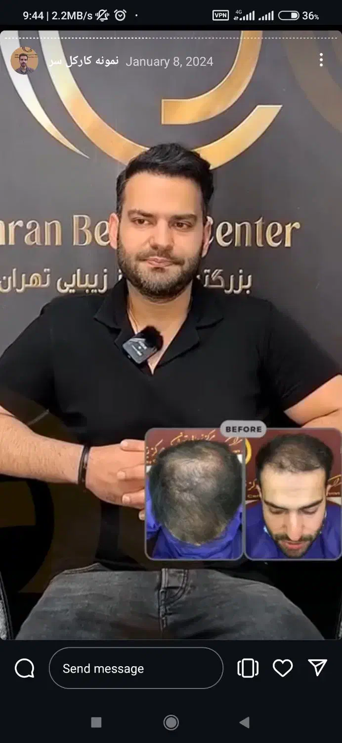 کاشت مو/تضمینی/توسط پزشک متخصص/نقد/اقساط|خدمات آرایشگری و زیبایی|پاکدشت, پاکدشت (مامازند)|دیوار