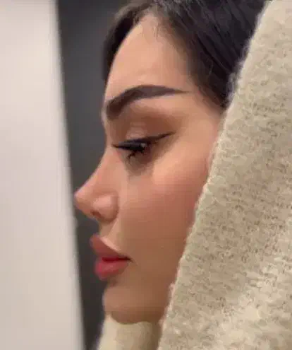 عمل بینی لیپوابدو لیفت غبغب دایرکت ابروتخفیف تهران|خدمات آرایشگری و زیبایی|قزوین, |دیوار