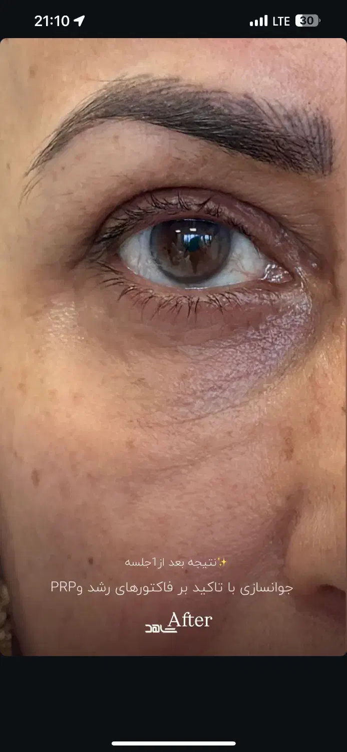 جشنواره ژل و بوتاکس و پی ار پی در مطب توسط پزشک|خدمات آرایشگری و زیبایی|شیراز, چوگیاه|دیوار