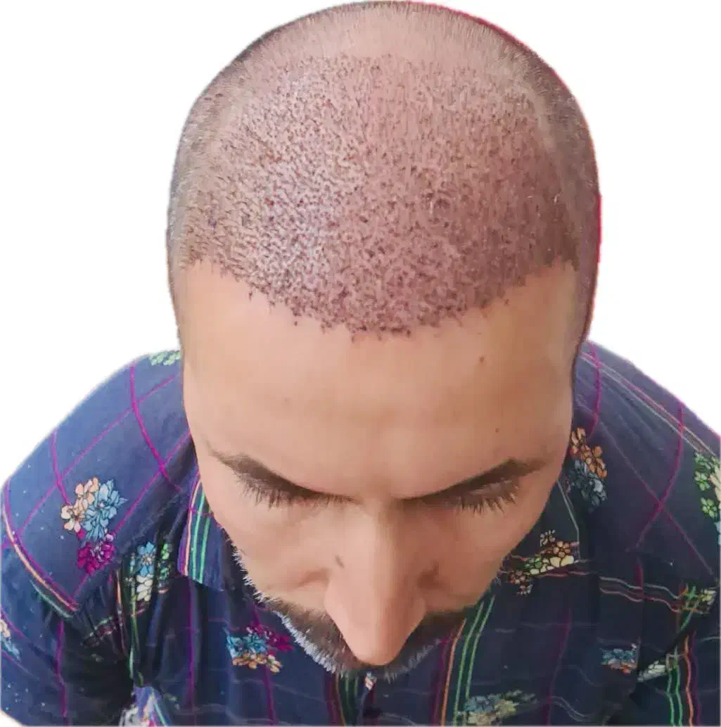 جشنواره کاشت مو و مزوتراپی|خدمات آرایشگری و زیبایی|مشهد, احمدآباد|دیوار