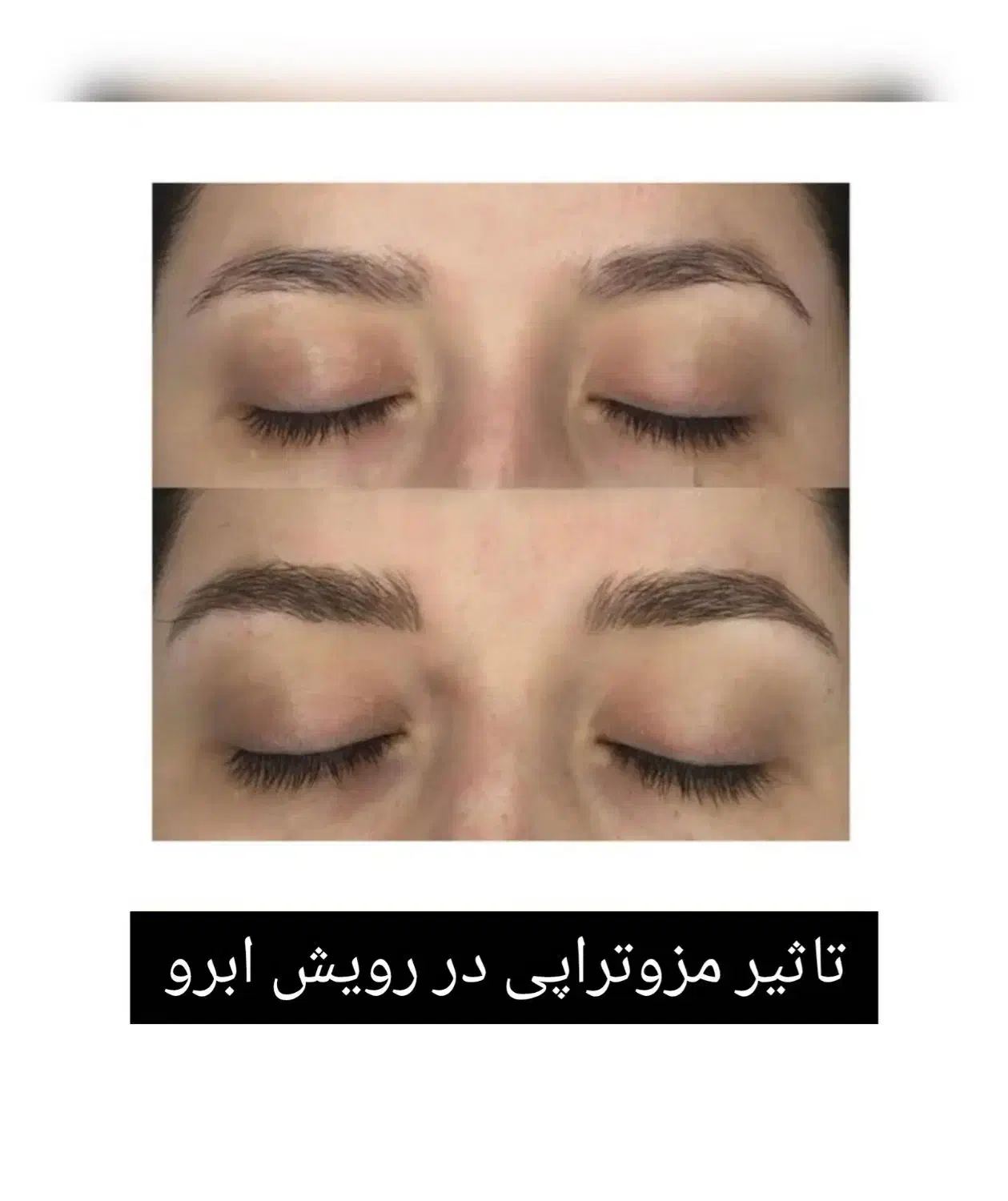 آف مزوتراپی و مزونیدلینگ|خدمات آرایشگری و زیبایی|اهواز, گلستان|دیوار