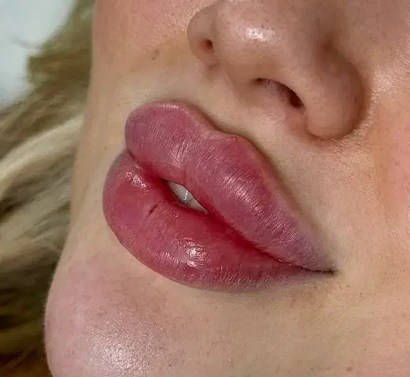 تزریق ژل / بوتاکس|خدمات آرایشگری و زیبایی|اردبیل, |دیوار