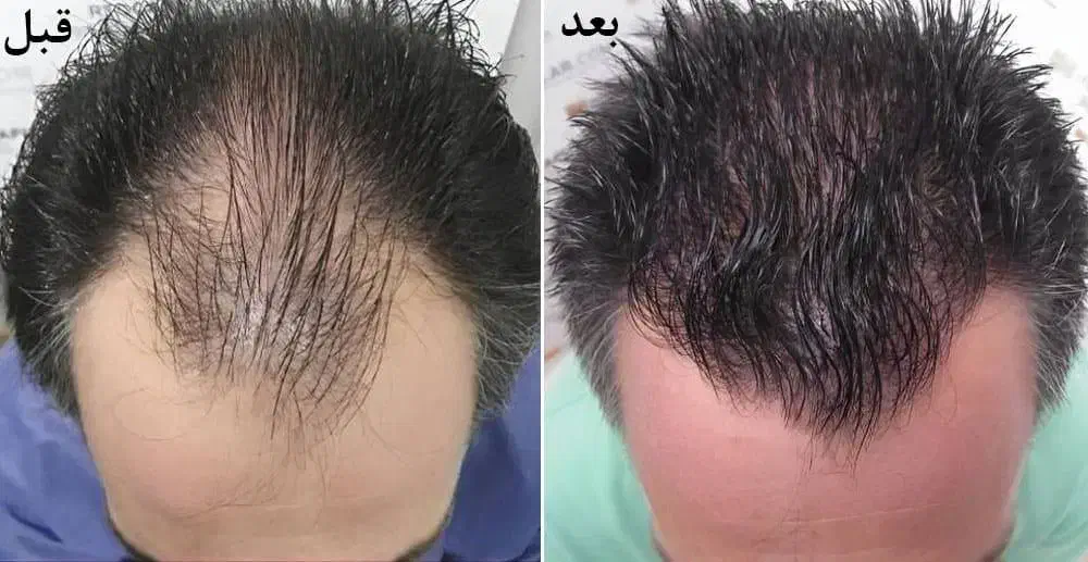 جشنواره تخفیف پی آر پی(PRP)/مزونیدلینگ مو و صورت|خدمات آرایشگری و زیبایی|اصفهان, جلفا|دیوار