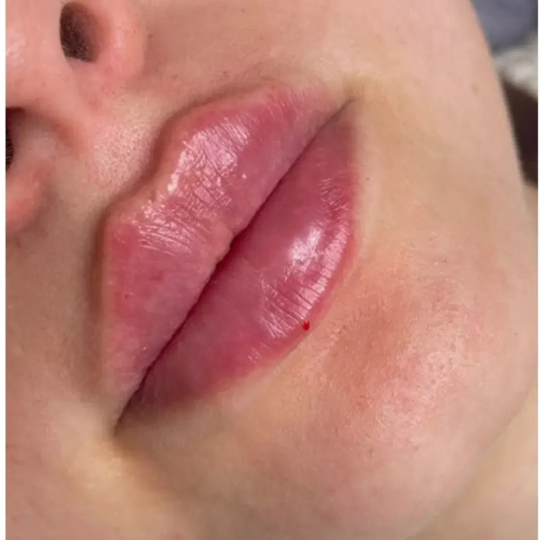 آموزش تزریق ژل و بوتاکس تضمینی|خدمات آموزشی|تهران, نیروی دریایی|دیوار