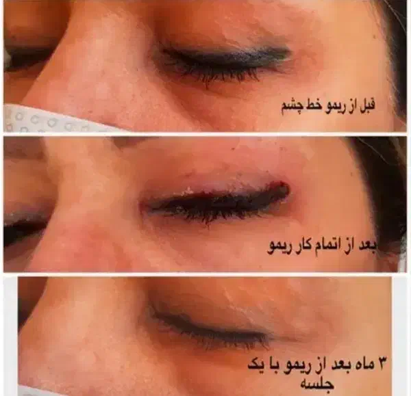 ریموو و آموزش تخصصی تاتو صورت ابرو تک جلسه ای|خدمات آرایشگری و زیبایی|قم, زنبیل آباد|دیوار