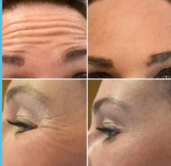 بوتاکس پیشانی،بوتاکس چشم گربه ای، لیزر موهای زائد|خدمات آرایشگری و زیبایی|خسروشاه, |دیوار