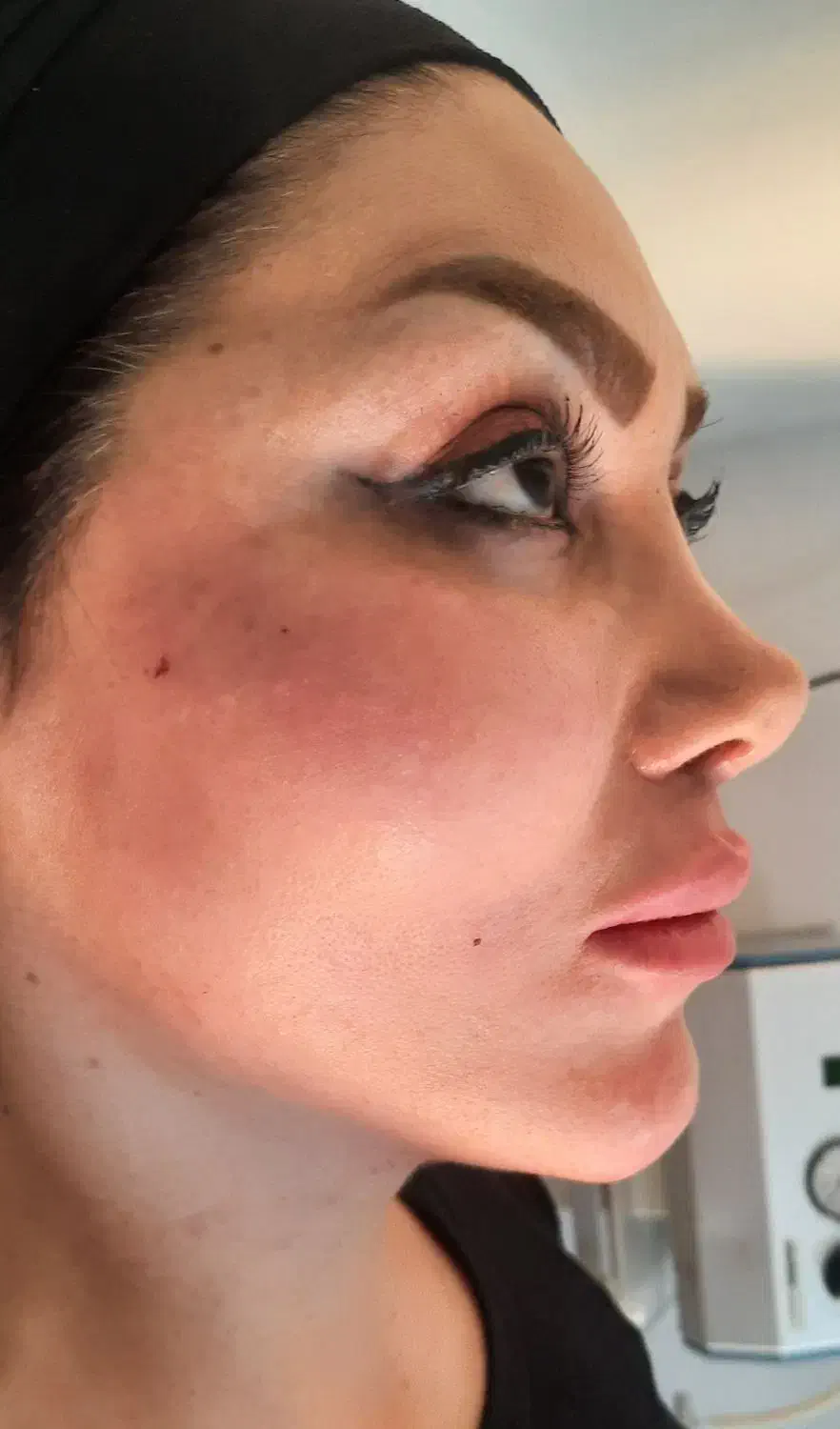 تزریق فیلر بوتاکس ساکشن چربی وتزریق چربی|خدمات آرایشگری و زیبایی|کرمانشاه, |دیوار