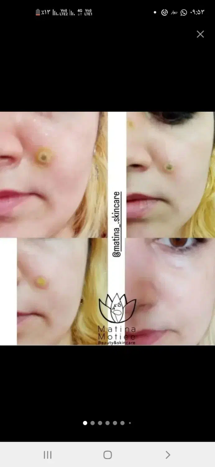 فیشال تخصصی، برداشت خال و ککو مک، ژل و بوتاکس|خدمات آرایشگری و زیبایی|شاهرود, |دیوار