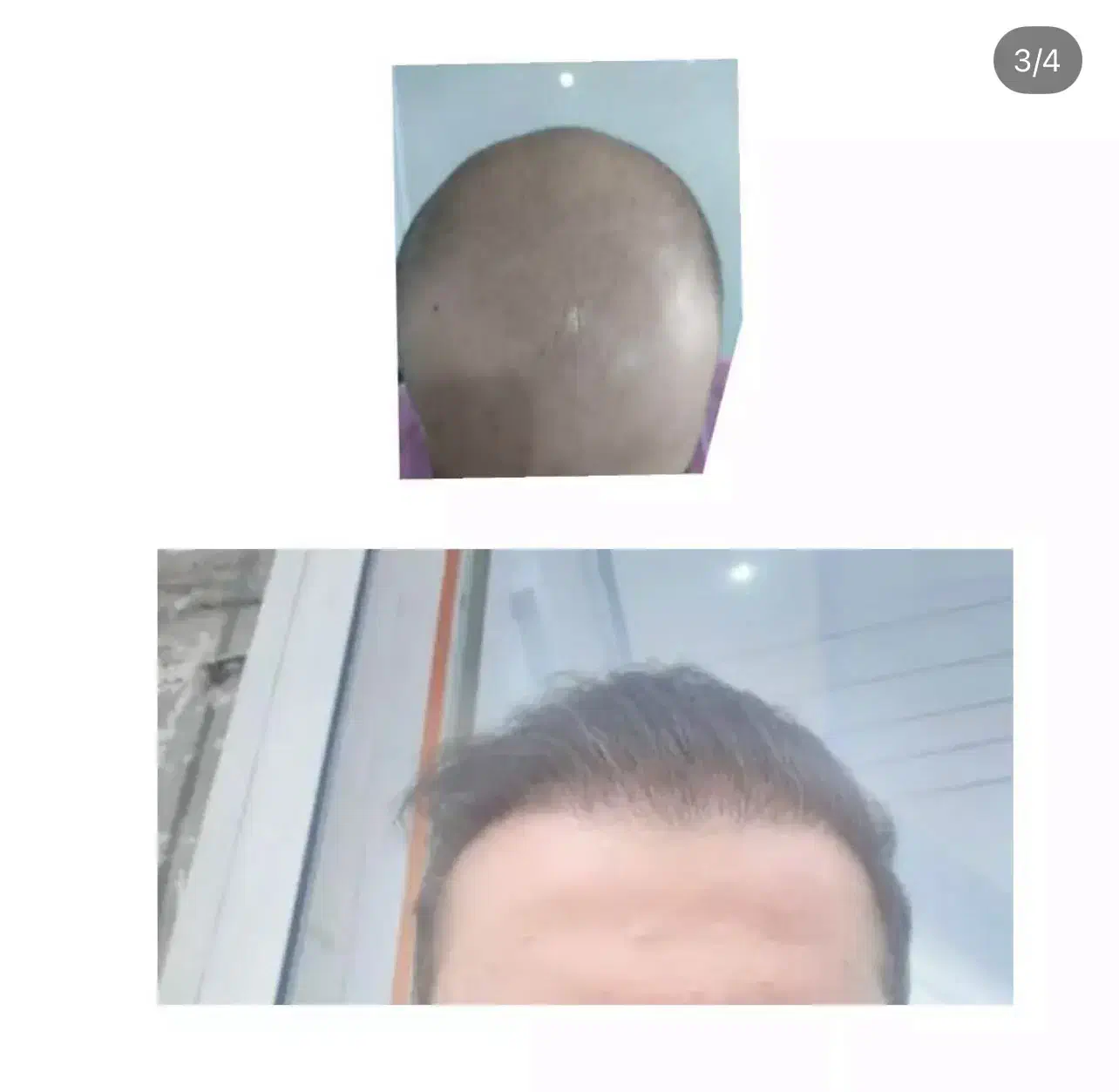 کاشت مو|خدمات آرایشگری و زیبایی|سلماس, |دیوار