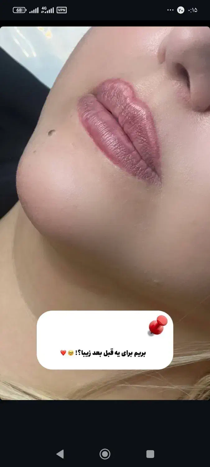 انجام تمامی خدمات فیلرو ساکشن و لابیا پلاستی|خدمات آرایشگری و زیبایی|کرمانشاه, |دیوار