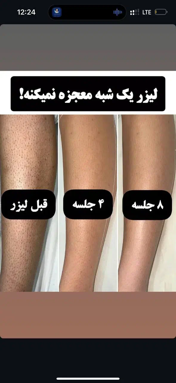 مجهزترین مرکز لیزر با دو دستگاه شاتی و رولی|خدمات آرایشگری و زیبایی|سبزوار, کاشفی شمالی (دادگستری)|دیوار