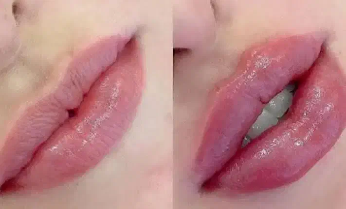 تزریق ژل و آنزیم غبغب وبینی وتزریق آنزیم تخلیه ژل|خدمات آرایشگری و زیبایی|اردبیل, |دیوار