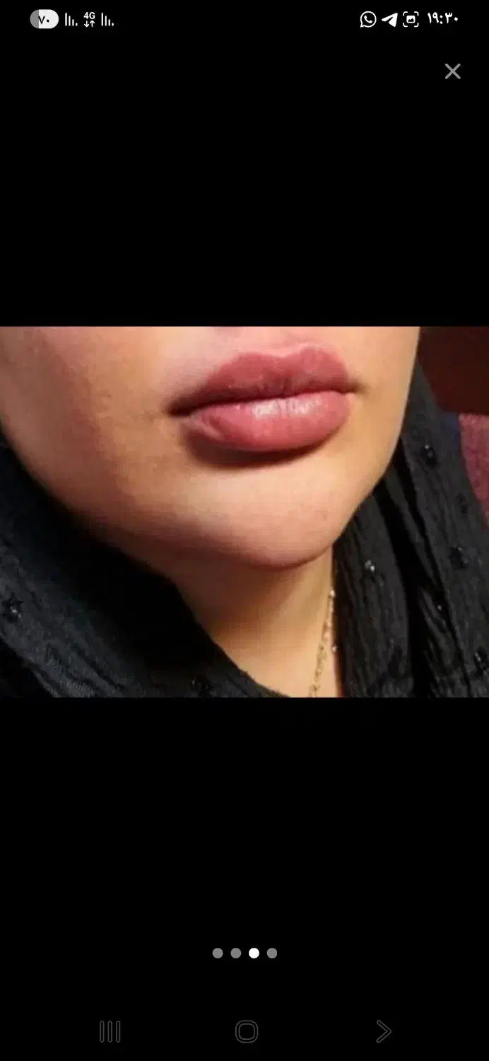 جشنواره تخفیف بوتاکس|خدمات آرایشگری و زیبایی|قم, صفاشهر|دیوار