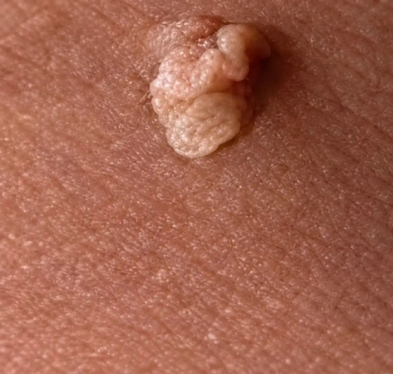 کلینیک اوینا درمان hpv و hsv و زگیل|آرایشی، بهداشتی، درمانی|تهران, ولنجک|دیوار