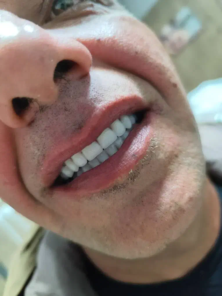 دندان مصنوعی وارداتی هر فک ۵ تومان|خدمات آرایشگری و زیبایی|کرج, کمالشهر|دیوار