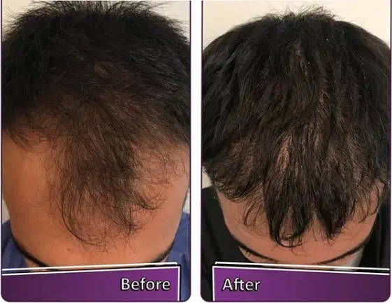 مزوتراپی مو ، ۳۰ درصد تخفیف برای جلسه اول|خدمات آرایشگری و زیبایی|نیشابور, ۲۲ بهمن|دیوار