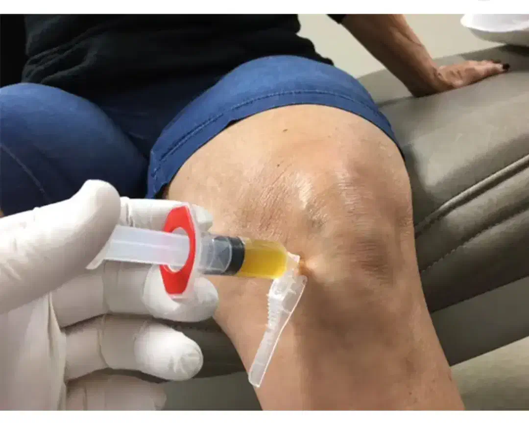 پی آر پی درمانی|پزشکی|شاهین‌شهر, عطار|دیوار