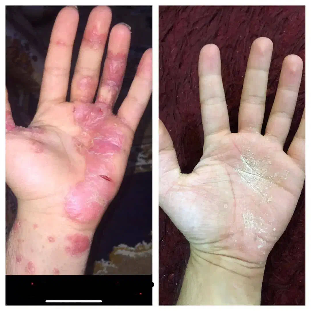 پیسی و پسوریازیس|خدمات آرایشگری و زیبایی|کرمانشاه, |دیوار